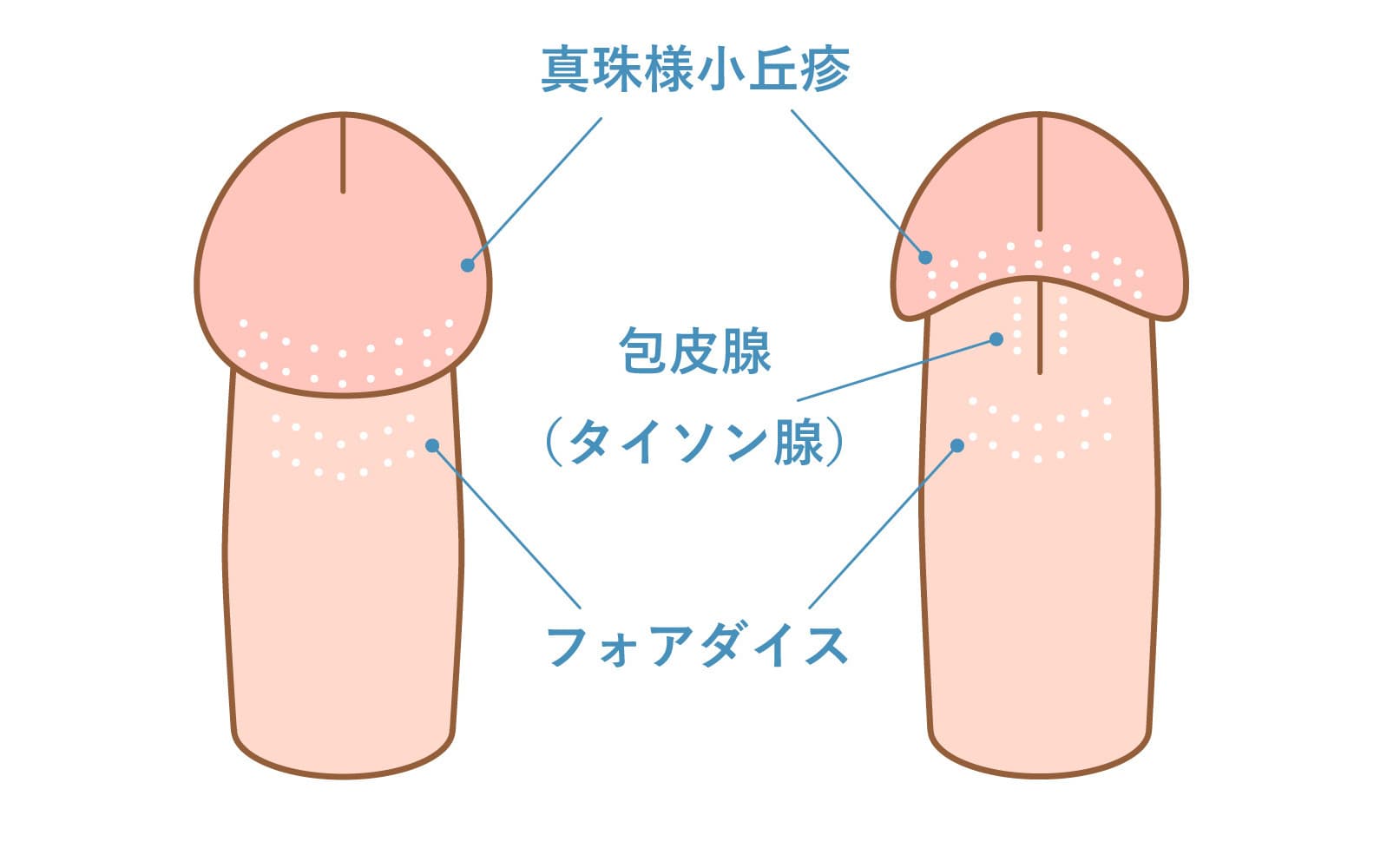 陰部のブツブツの治療 フォアダイス 包皮腺 真珠様小丘疹 しむら皮膚科クリニック 新潟市 陰部のブツブツの治療 フォアダイス 包皮腺 真珠様小丘疹 しむら皮膚科クリニック 新潟市