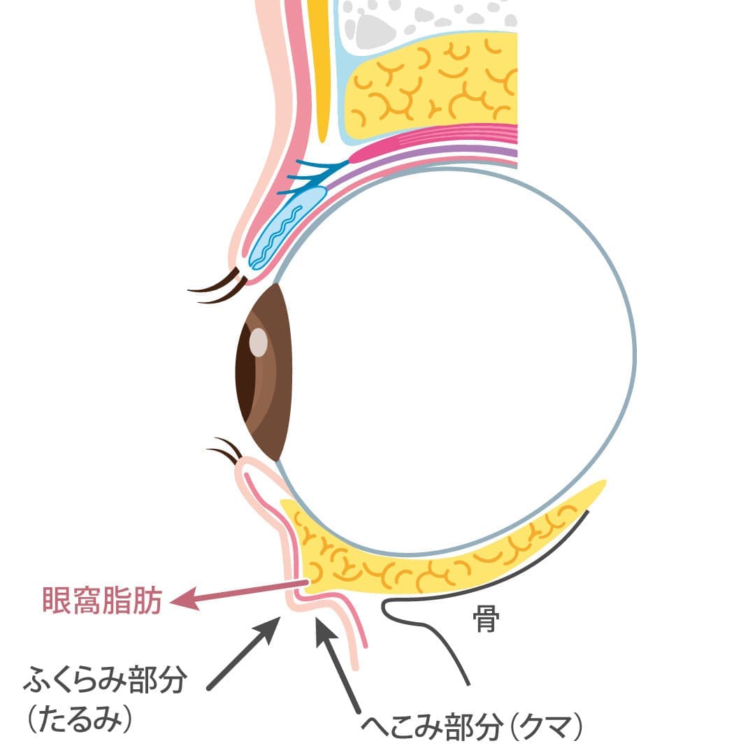 経結膜下脱脂法の施術前