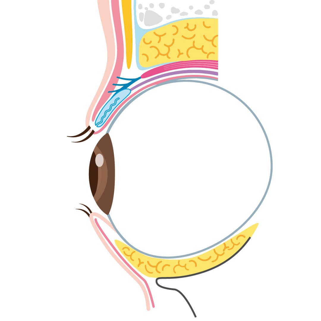 経結膜下脱脂法の施術後イメージ