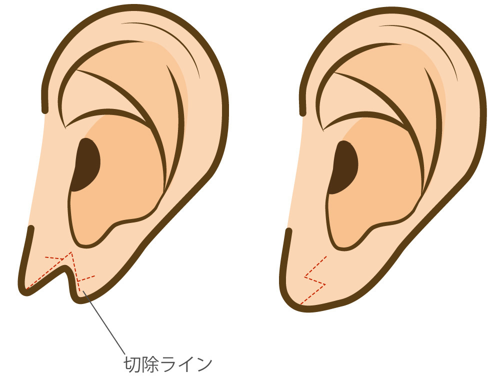 耳垂裂のZ形成術