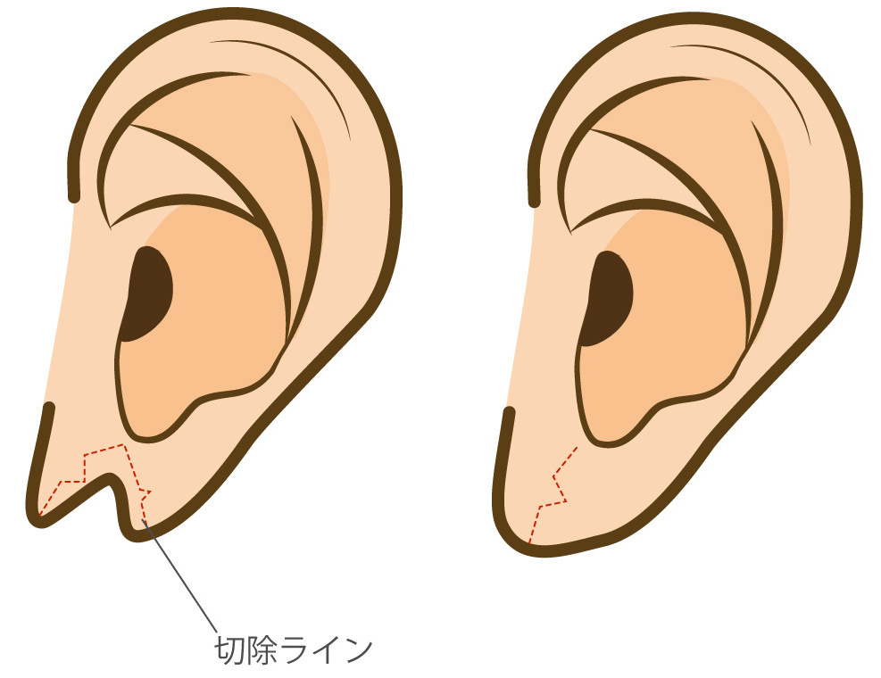 耳垂裂のW形成術