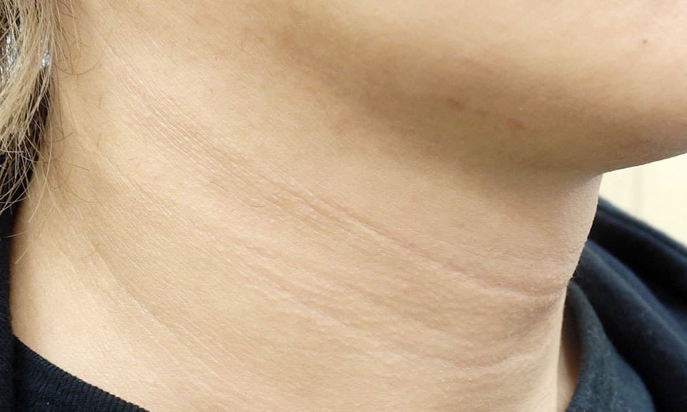 PRP首のシワ治療後左側