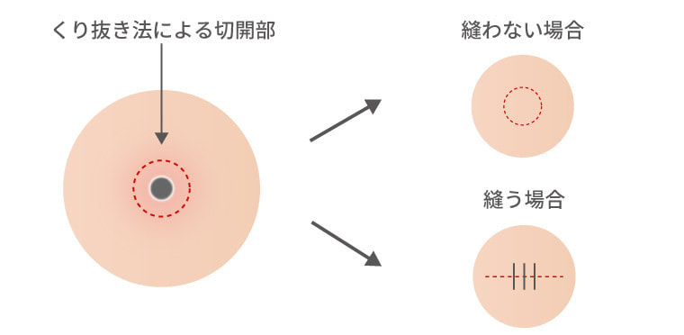 粉瘤 ふんりゅう くり抜き法 手術 しむら皮膚科クリニック 新潟市 粉瘤 ふんりゅう くり抜き法 手術 しむら皮膚科クリニック 新潟市