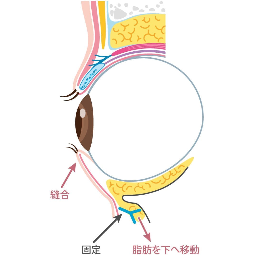 表ハムラ法の施術後イメージ