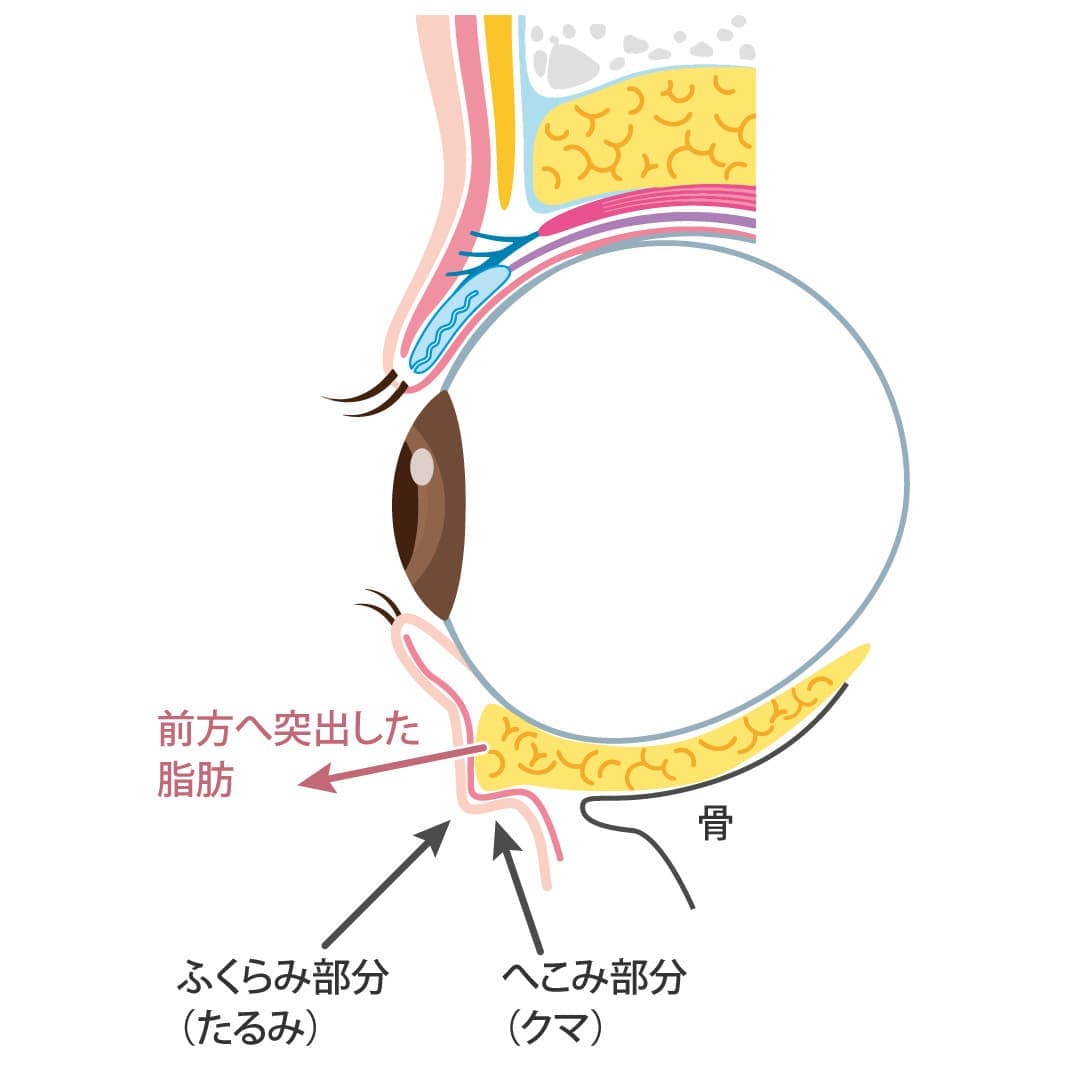 裏ハムラ法の施術①