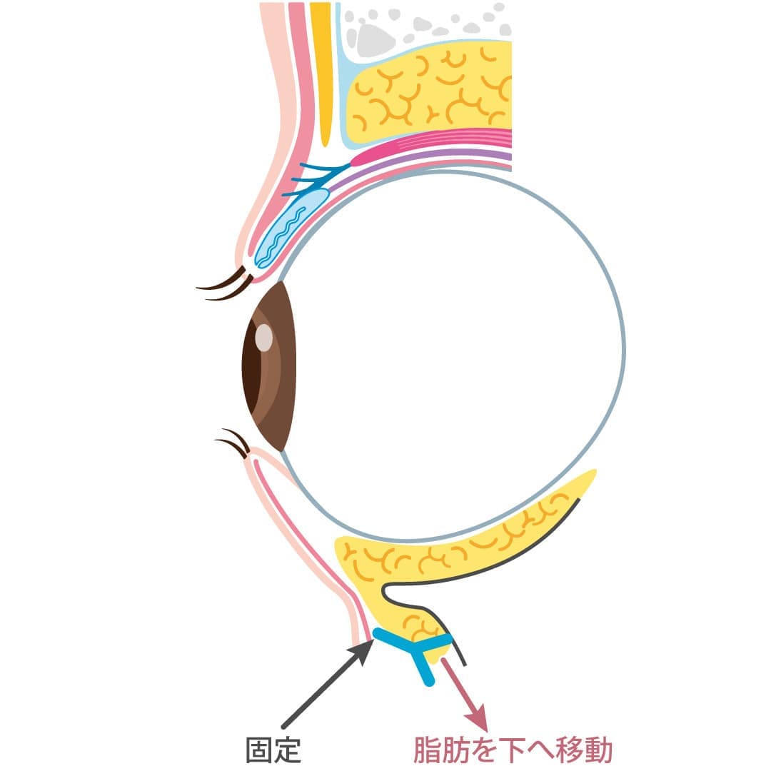 裏ハムラ法の施術③