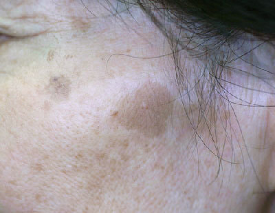 治療前の頬部に生じた老人性色素斑