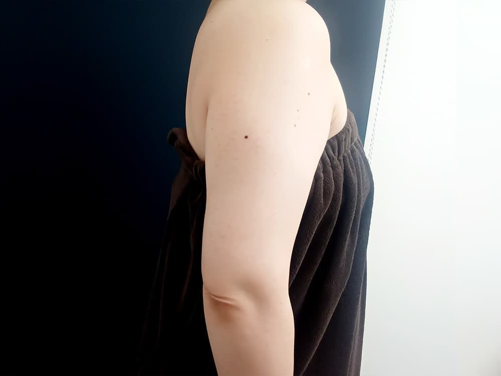 クールテック二の腕の施術2回後