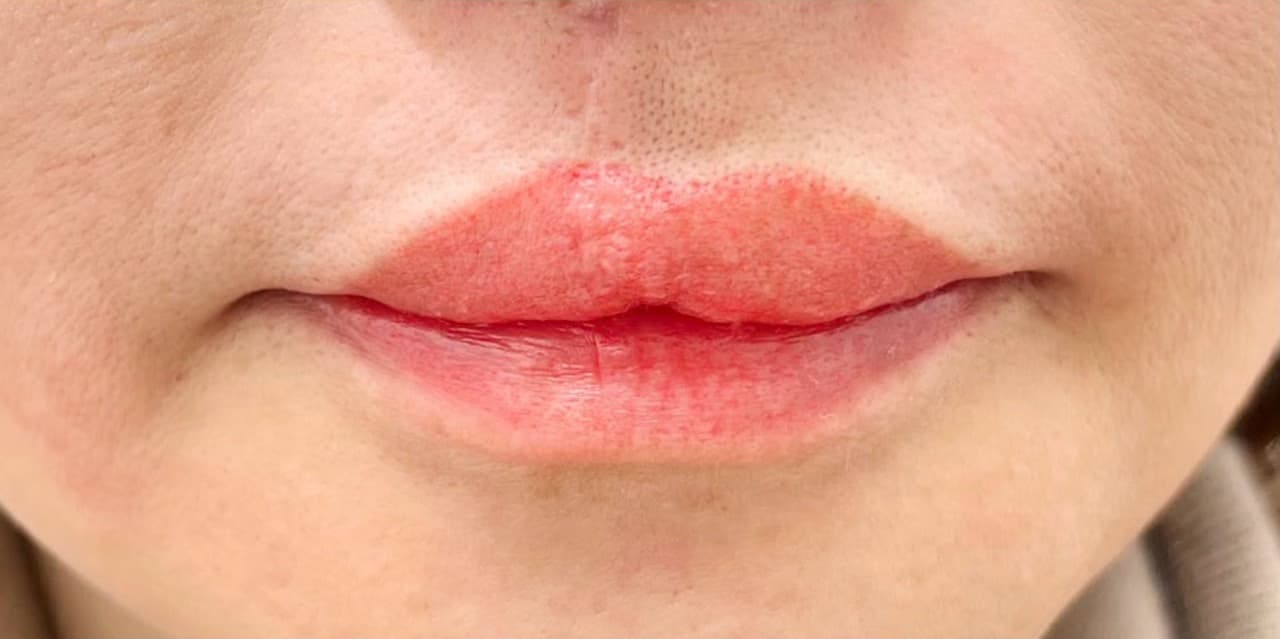 口唇口蓋裂のアピアランスケアによるリップアートメイク施術後