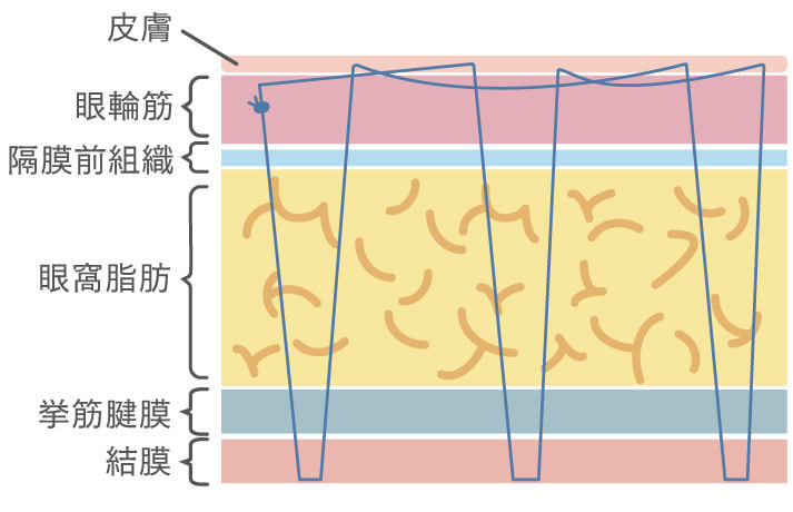 多点挙筋法のイメージ