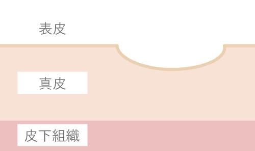 ニキビ跡(クレータータイプ)