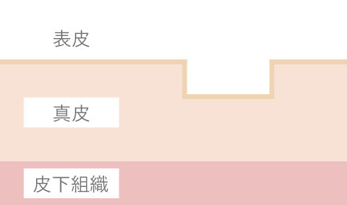 ニキビ跡(ボックスタイプ)