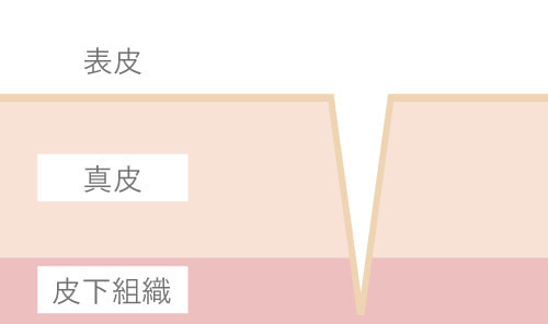 ニキビ跡(アイスピックタイプ)