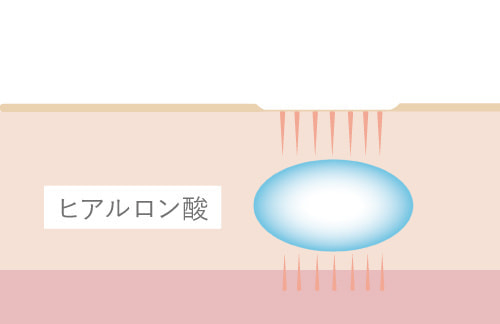 ヒアルロン酸を注入