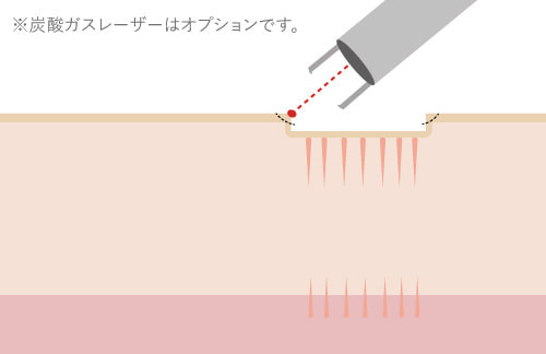 炭酸ガスレーザーによるサブシジョン治療