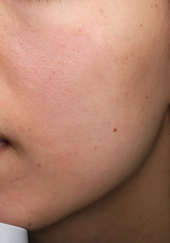 ソフウェーブ施術前