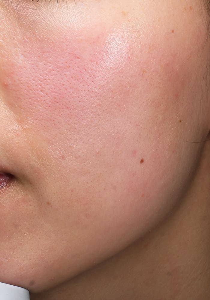 ソフウェーブ施術約１ヶ月後