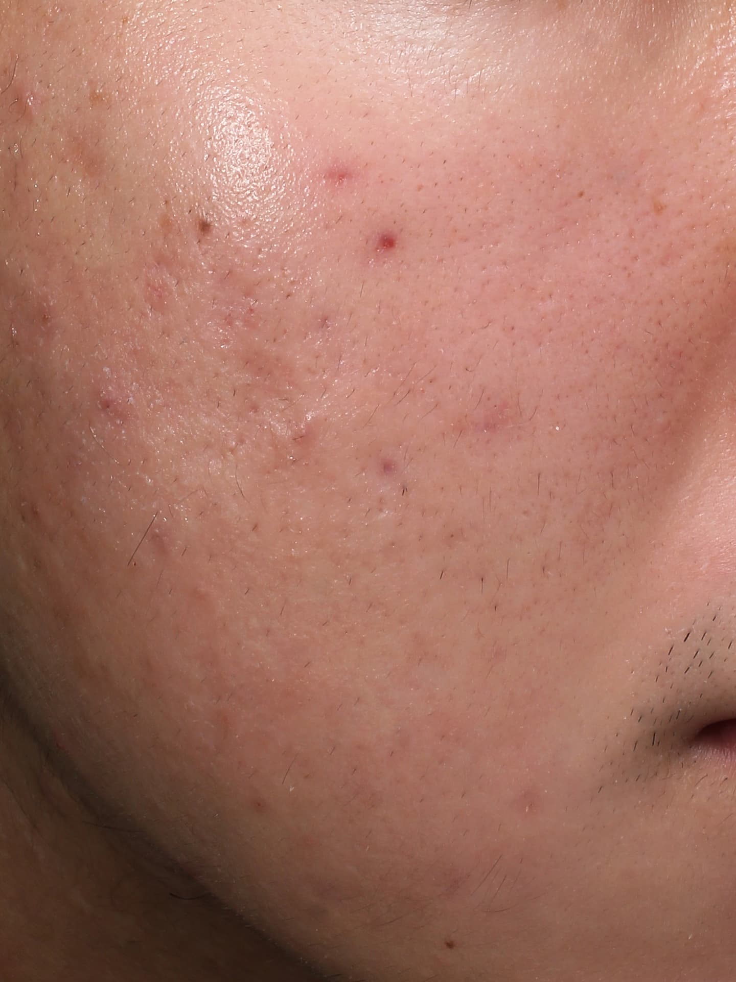 キュアジェット施術後