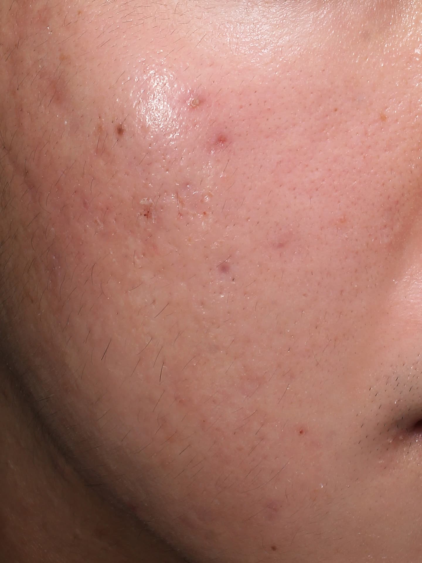 キュアジェット施術前