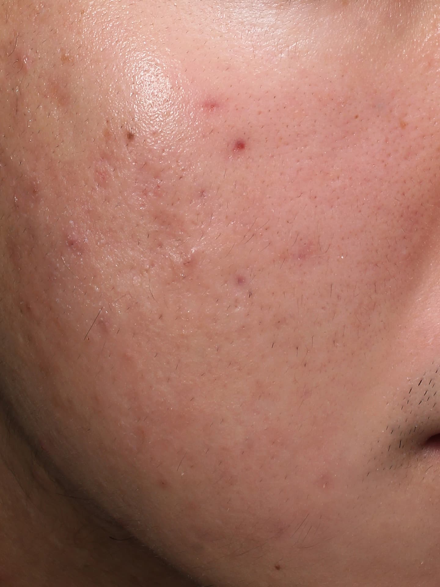 キュアジェット施術後