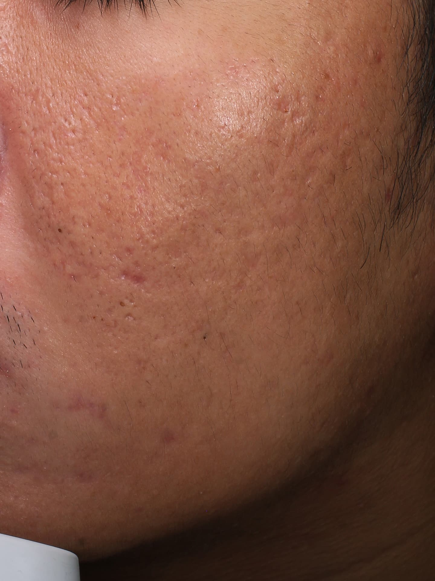 キュアジェット施術前