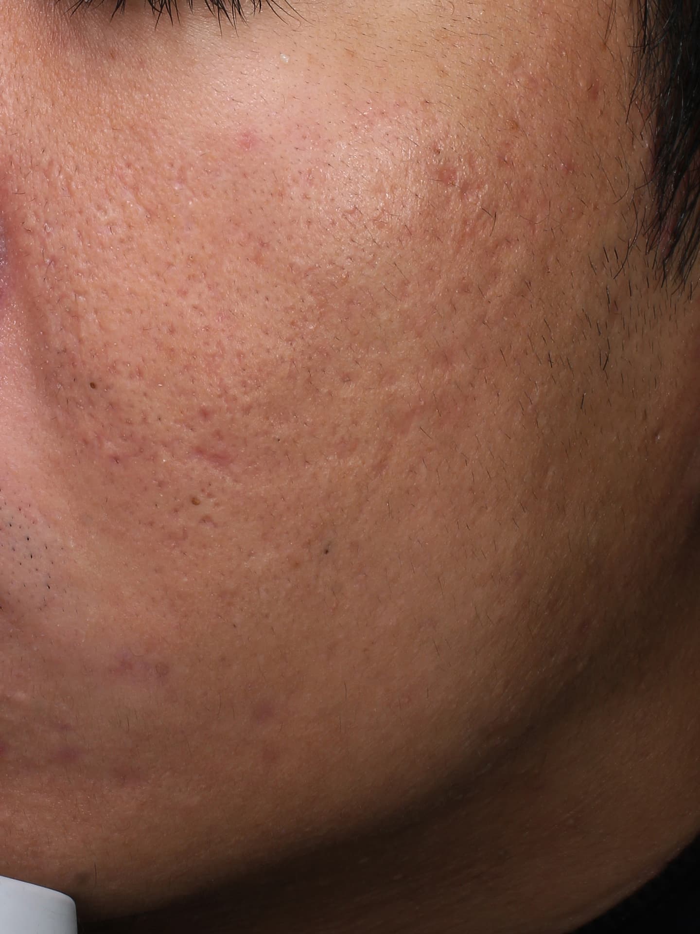 キュアジェット施術後