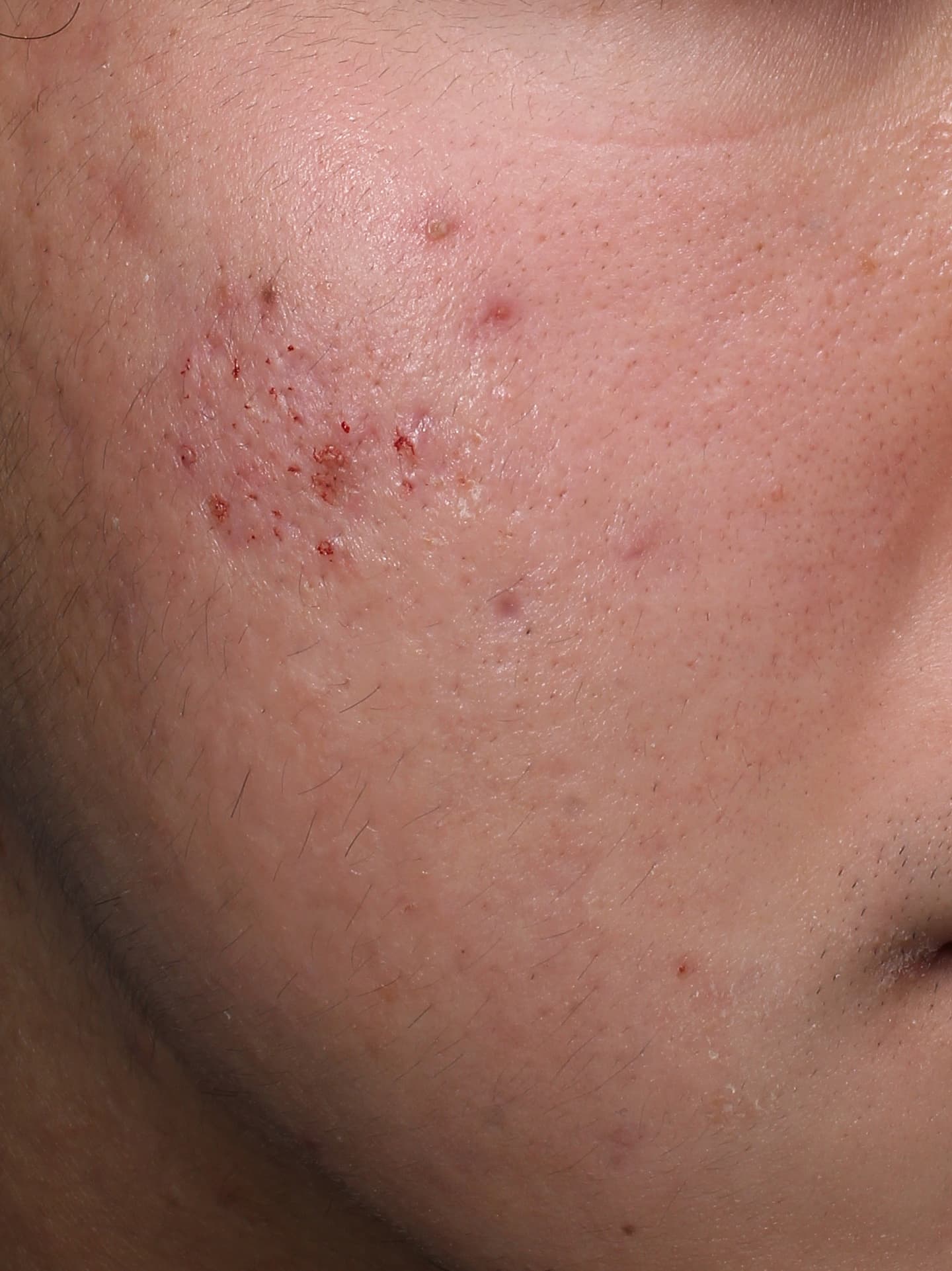 キュアジェット施術直後