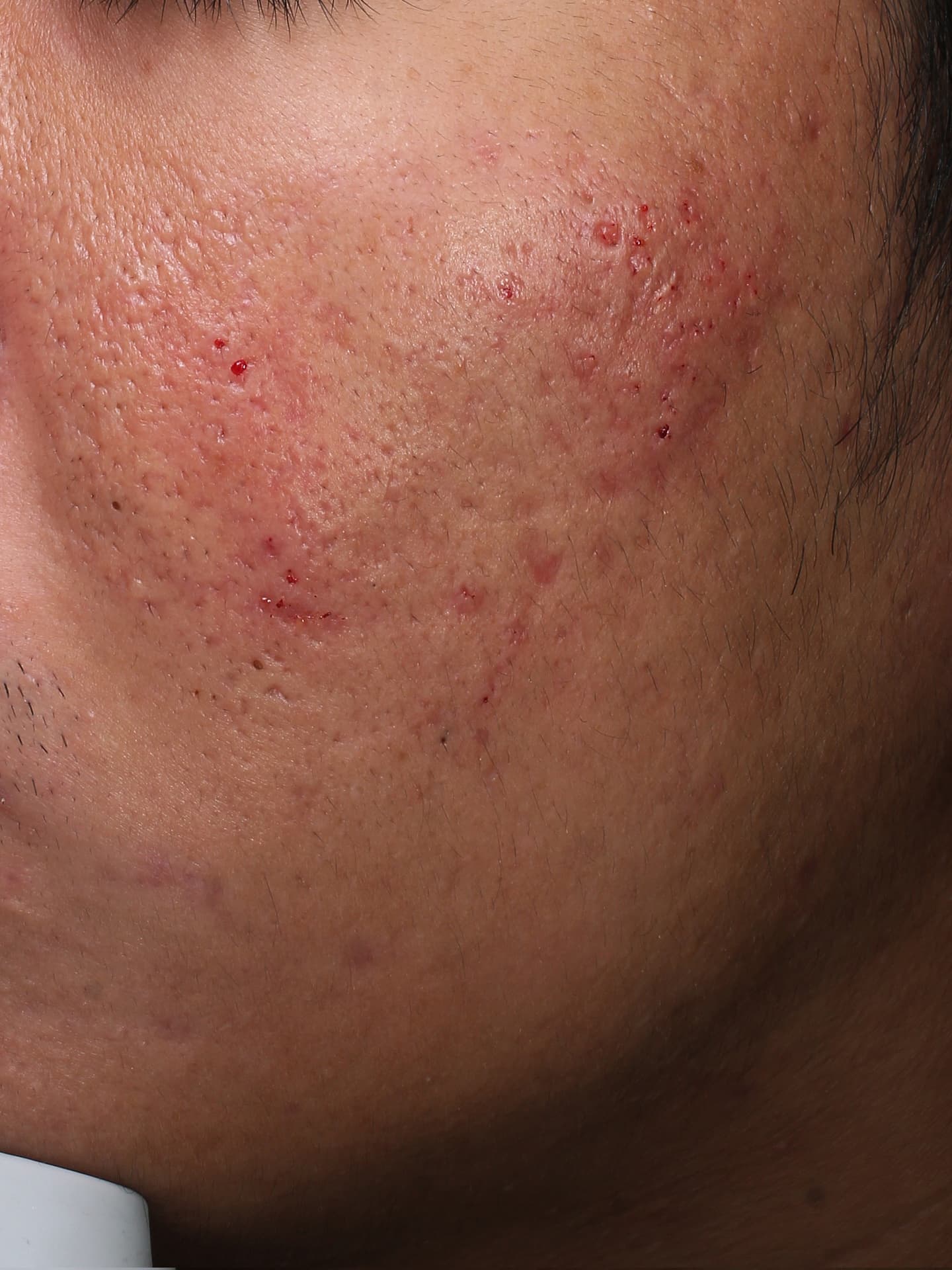 キュアジェット施術直後