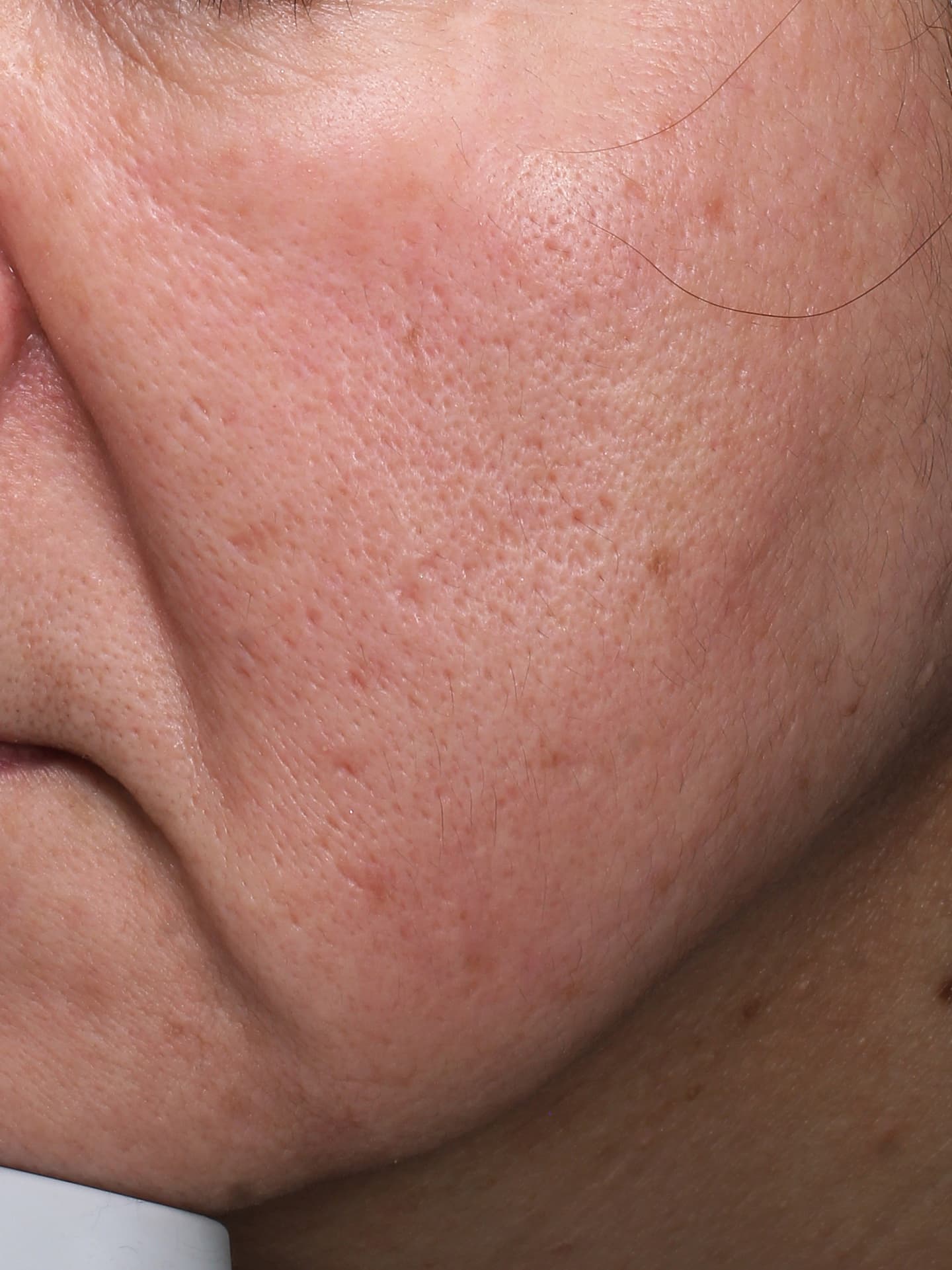 ソフウェーブ施術約１ヶ月後