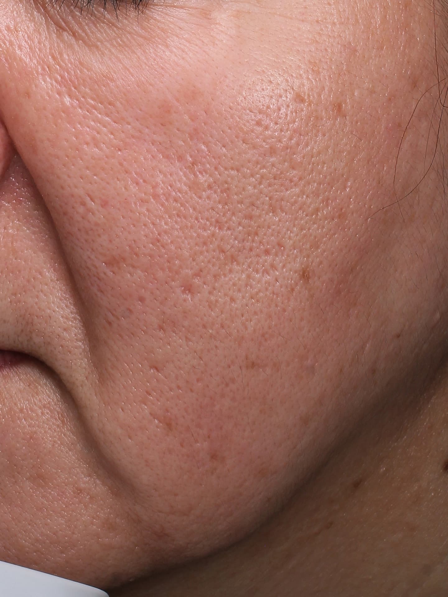 ソフウェーブ施術前