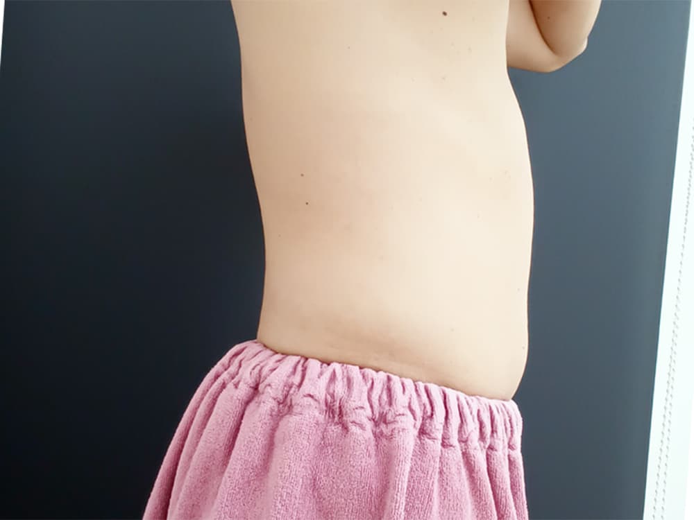 クールテック施術前