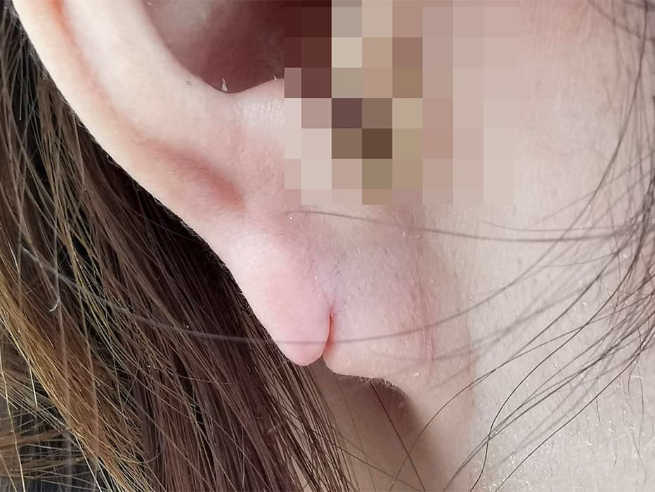 耳垂裂治療前