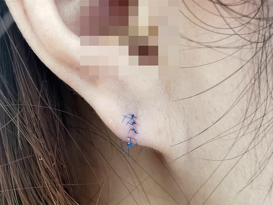 耳垂裂手術１週間後抜糸前