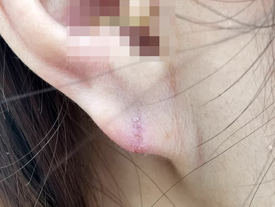 耳垂裂手術１週間後抜糸前
