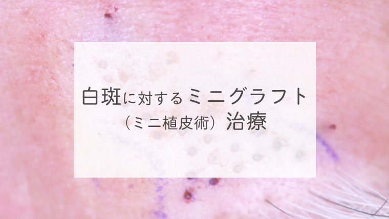 白斑に対するミニグラフト（ミニ植皮術）治療