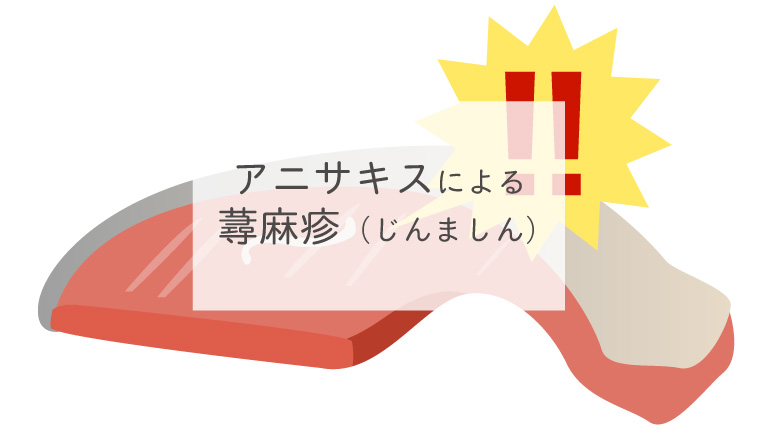 アニサキスによる蕁麻疹（じんましん）