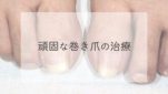 巻き爪の治療（ワイヤー法）