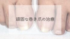 巻き爪の治療（ワイヤー法）