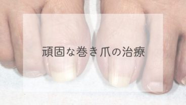 巻き爪の治療（ワイヤー法）