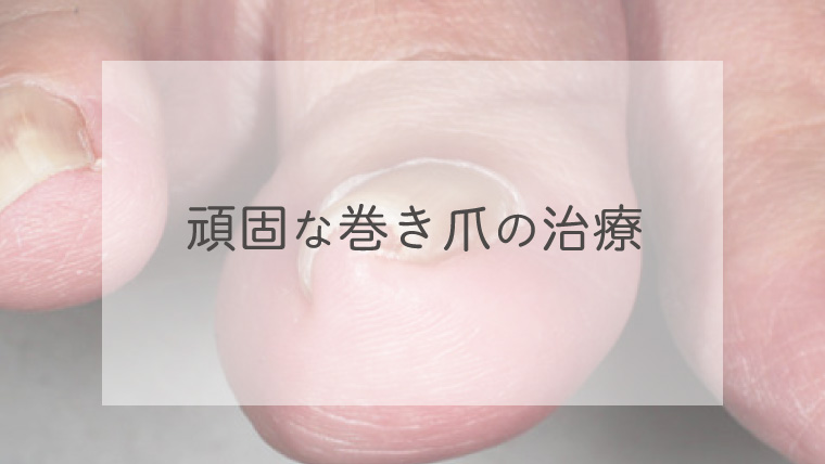 巻き爪の治療（ワイヤー法）