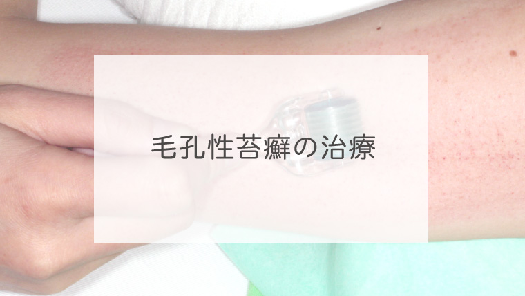 毛孔性苔癬の治療