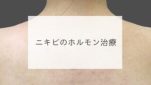 ニキビのホルモン治療