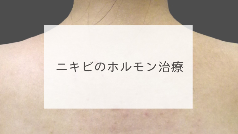 ニキビのホルモン治療