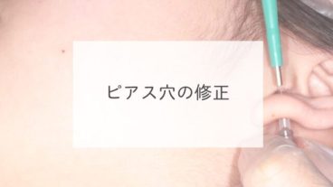 ピアス穴の修正