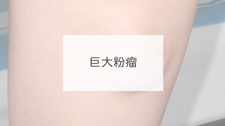 巨大粉瘤