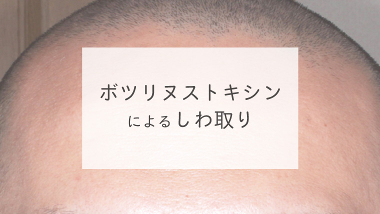 ボツリヌストキシンによるしわ取り
