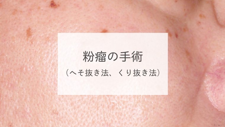 粉瘤の手術（へそ抜き法、くり抜き法）