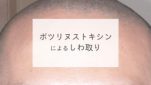 ボツリヌストキシンによるしわ取り