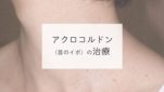 アクロコルドン（首のイボ）の治療