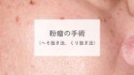 粉瘤の手術（へそ抜き法、くり抜き法）